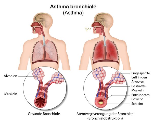Asthma bronchiale Bronchokonstriktion